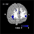 brain scan showing prefrontal cortex