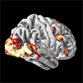 social anxiety brain scan