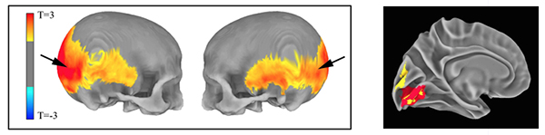 MRI data shows (left) areas of the skull preferentially affected by the amount of Neanderthal-derived DNA and (right) areas of the brain’s visual system in which Neanderthal gene variants influenced cortex folding (red) and gray matter volume (yellow).