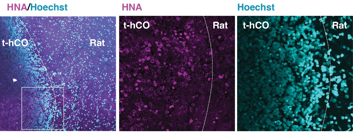 Image showing transplanted human cortical organoids made from cells taken from individuals with Timothy syndrome with immunostaining. Chen et al., Nature.  